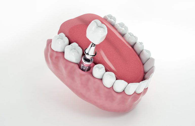 Imagen 3D de implante dental de circonio. Trabajos con resina acrílica y circonio